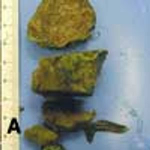 Small Bowel Obstruction Secondary to a Large Phytobezoar