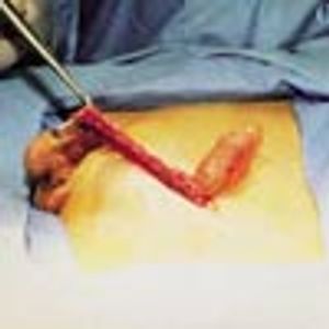 Hydrocele of the Cord