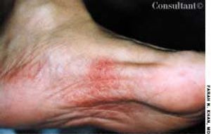 Stevens-Johnson Syndrome Due to Levofloxacin Hypersensitivity