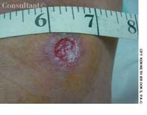 Cutaneous Leishmaniasis (“Baghdad Boil”)