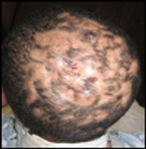Dissecting Cellulitis of the Scalp