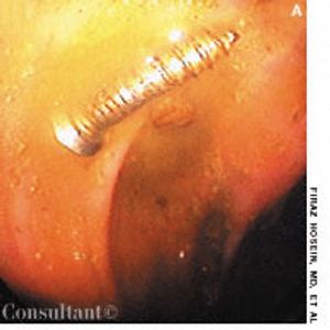 Infantile Perianal Pyramidal Protrusion