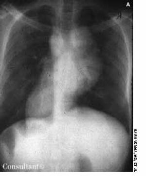 Thymoma