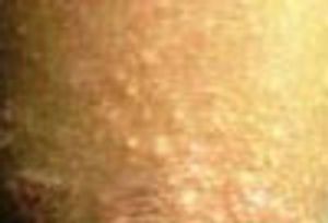 Non-Resolving Dermatitis in a 9-Year-Old Boy