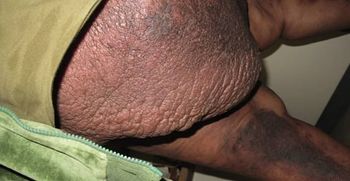 Lipodermatosclerosis and Elephantiasis Nostras Verrucosa