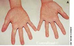 Atopic Dermatitis
