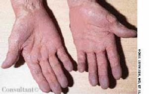 Palmar Erythema