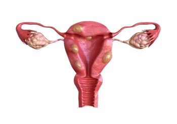 Untreated, New-Onset Hypertension Tied to Higher Risk of Uterine Fibroids in Women / Image credit: ©AGPhotography/AdobeStock