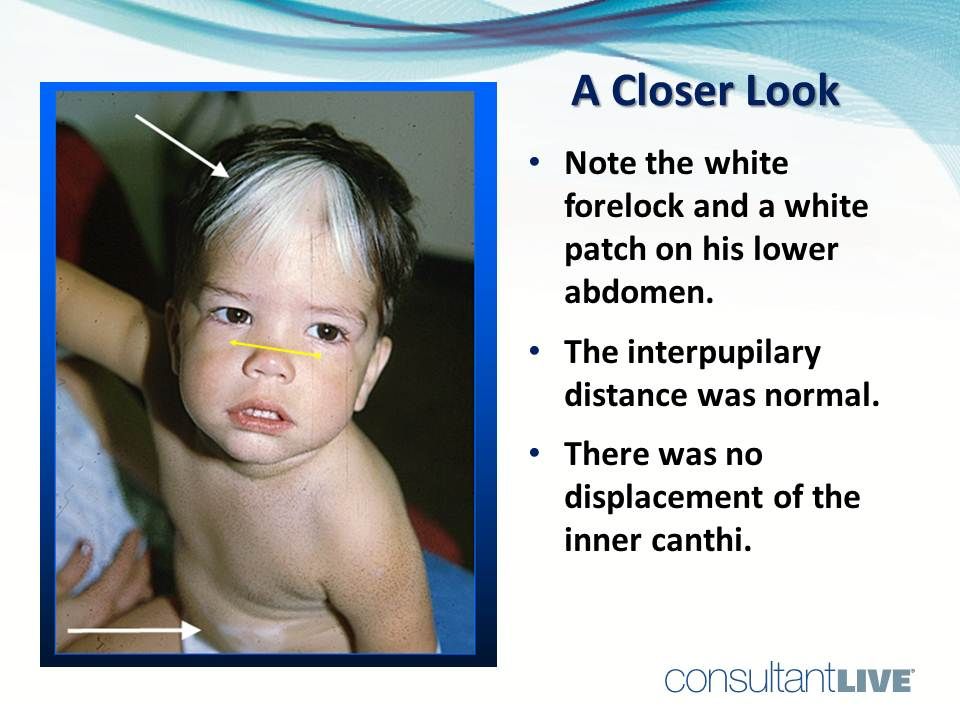 Back Forelock A Young Boy with a White Forelock
