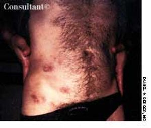 Cutaneous T-Cell Tumor