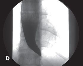 semaglutide achalasia Concurrent Management of Achalasia and Morbid Obesity