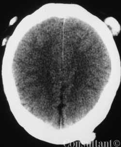 Gardner Syndrome Gardner Syndrome