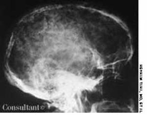 Multiple Myeloma