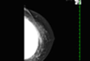 Late Infection of Ruptured Silicone Breast Implant for Breast Augmentation