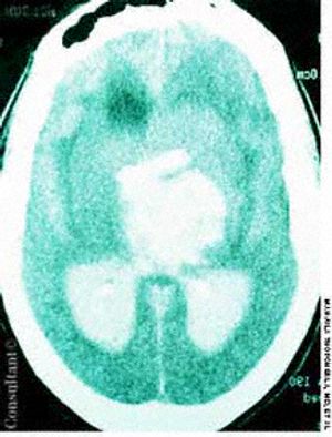 Intracerebral Hemorrhage