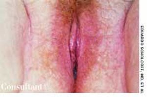 Vulvar Melanosis