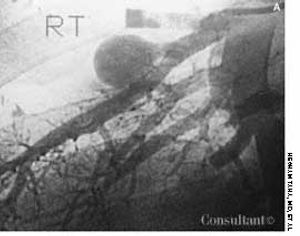 Hughes-Stovin Syndrome