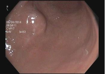 Subepithelial lesion in the antrum