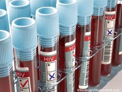 Real-World Study Finds Long-Acting Cabotegravir+Rilpivirine Highly Effective in Persons with HIV with Detectable Viral Loads at Treatment Inititiaton 