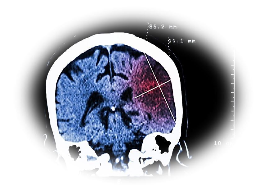 Bayer's Asundexian Reduces Ischemic Stroke Risk Without Raising Major Bleeding in Phase III Trial / image credit  ©Puwadol Jaturawuttichai/shutterstock.com
