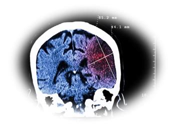 Milvexian Added to Standard DAPT Fails to Reduce Stroke Risk, May Increase Risk of Bleeding / image credit stroke ©Puwadol Jaturawuttichai/stock.adobe.com