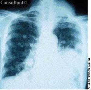 Renal Cell Carcinoma Metastases to the Lung