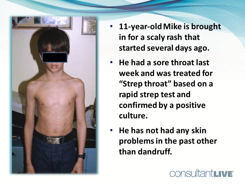 A young male has a rash after having a strep throat. 