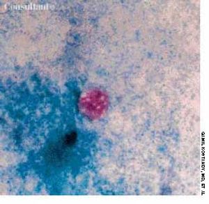 Cyclospora cayetanensis and AIDS