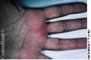 Herpes Simplex of the Hand