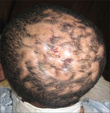 benzoyl peroxide scalp