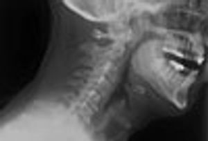Epiglottitis in a 48-Year-Old Man