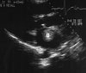 Left Atrial Ball Thrombus
