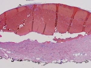 Histopathology, enoxaparin dermatosis