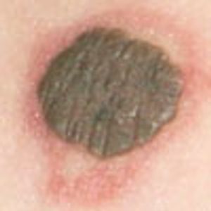 Congenital Nevomelanocytic Nevus