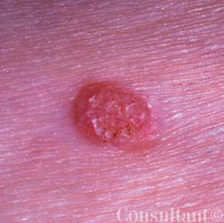 Inverted Follicular Keratosis on the Lower Lip | Patient Care Online