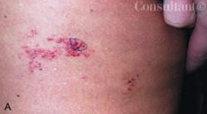 Lymphangioma Circumscriptum