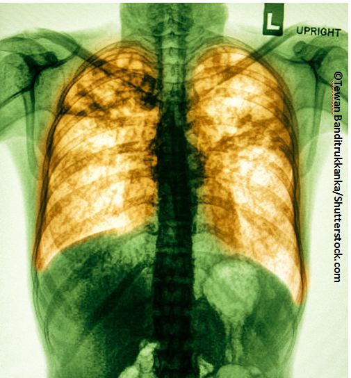 PPI Use Upped Risk for Community-Acquired Pneumonia