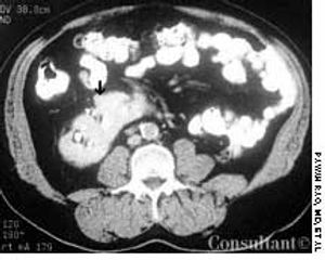 Crossed Renal Ectopia With Fusion