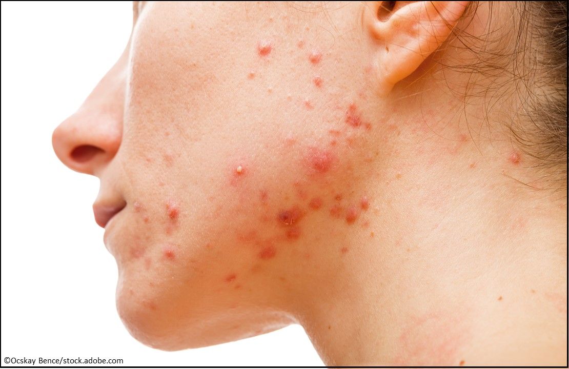 Arazlo (tazarotene) Lotion, acne medication, dermatology, acne skin, severe acne