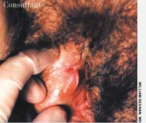 Vulvar Intraepithelial Neoplasia in a 67-Year-Old Woman