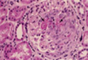 A Middle-Aged Man With Recurrent Pneumonia and Renal Failure