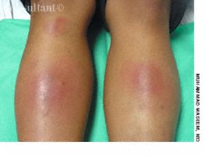 Erythema Nodosum on Shins of a 16-Year-Old Girl