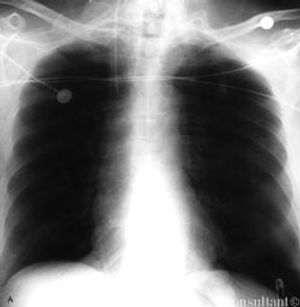 Malpositioned Nasogastric Tube