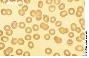 Cerebral Malaria