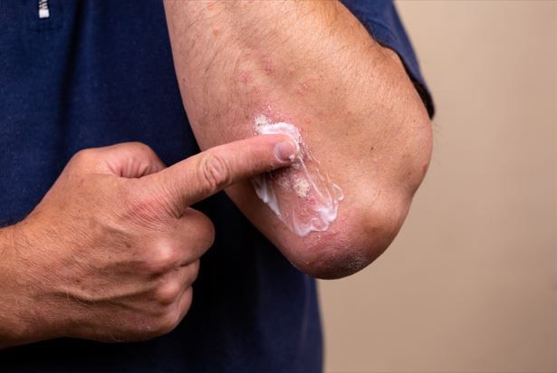 Turn Therapeutics Launches First Clinical Trial to Assess Topical IL-36 Inhibitor for Atopic Dermatitis / image credit ©lunarts_studio/stock.adobe.com
