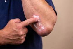 Turn Therapeutics Launches First Clinical Trial to Assess Topical IL-36 Inhibitor for Atopic Dermatitis 