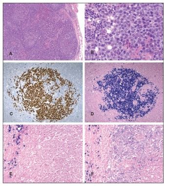 Multicentric Castleman Disease, Kaposi Sarcoma, Hemophagocytic