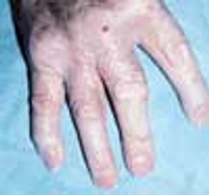 Rheumatoid Arthritis: Cutaneous Lesions 