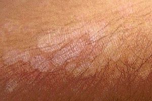 An Unusual Summer Tan