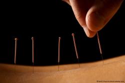 Acupuncture May be a Viable, Effective Treatment Option for IBS, Suggests New Research